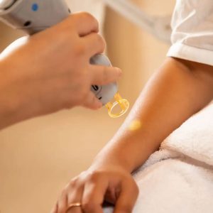 Épilation du torse, du ventre et des bras à la lumière pulsée chez Hemera, institut de beauté à Lille