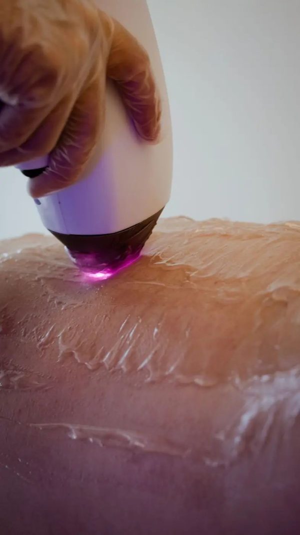 Épilation du maillot homme à la lumière pulsée Épilation du maillot homme à la lumière pulsée chez Hemera, institut de beauté à Lille